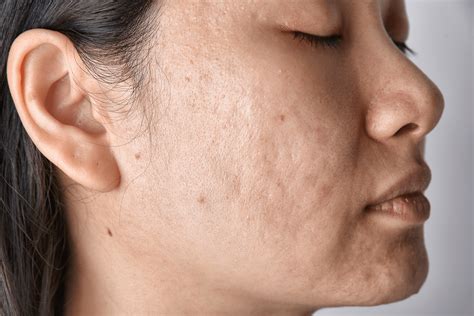 boni scars|5 Types of Acne Scars and How to Treat Them